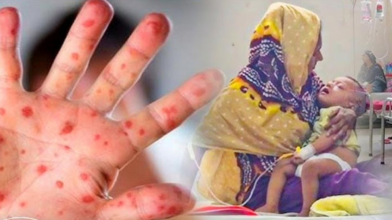হামে শিশু মৃত্যু, দায় এড়ানোর সুযোগ নেই বিএনপির