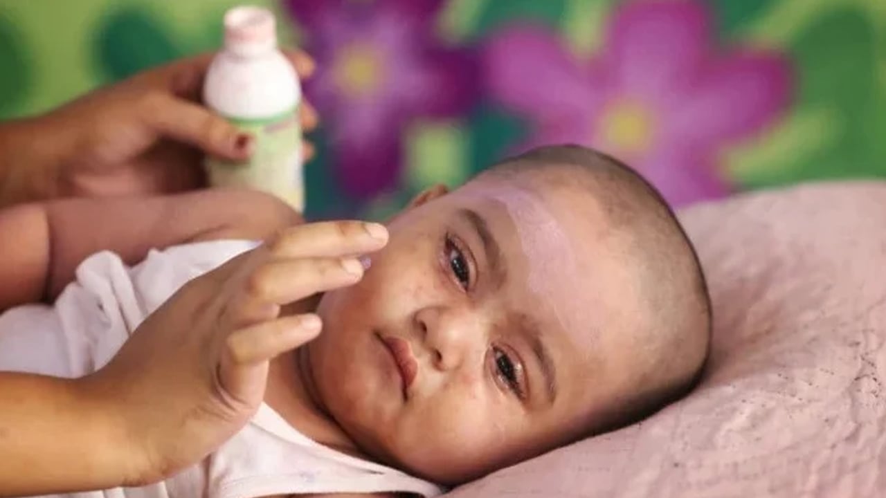 ২৪ ঘণ্টায় হামে প্রাণ গেল আরো ৪ শিশুর, আক্রান্ত ১০০৮

