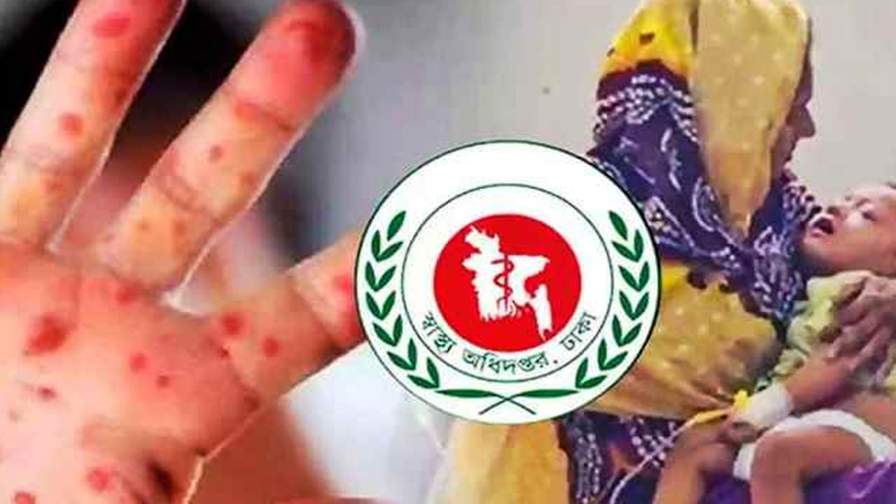 গত ২৪ ঘণ্টায় হামের উপসর্গে ৫ শিশুর মৃত্যু