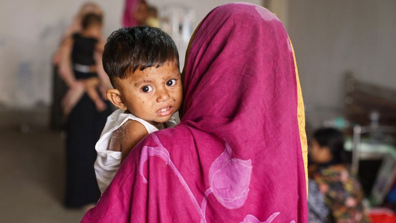 হাম ও উপসর্গ নিয়ে ২৮ দিনে ১৬৯ শিশুর মৃত্যু