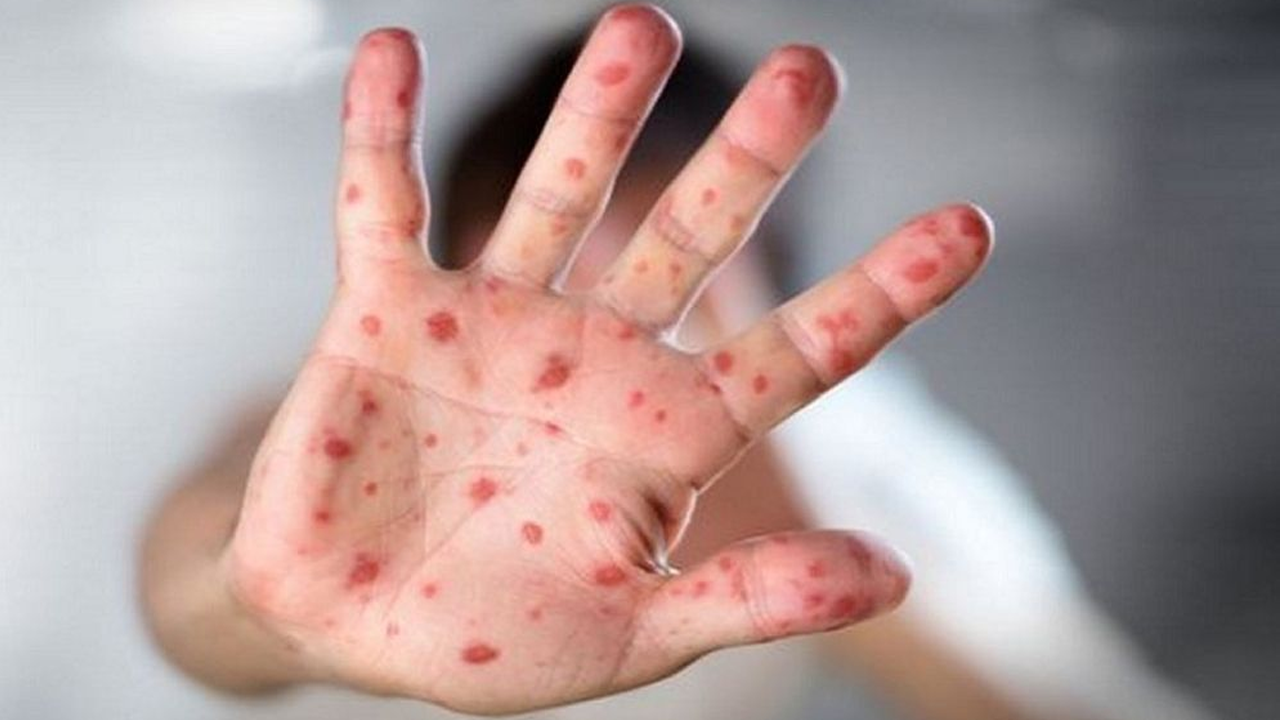 হাম ও হামের উপসর্গ নিয়ে আরও ৯ শিশুর মৃত্যু