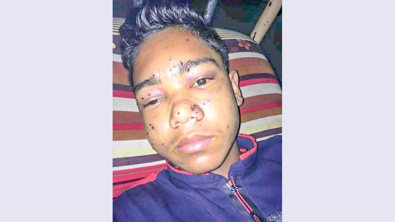 বিএসএফের বুলেটে চোখ হারিয়ে অনিশ্চিত জীবন