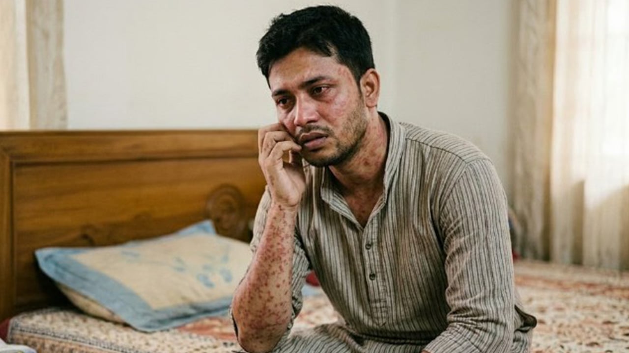 হাম হতে পারে বড়দেরও, জেনে নিন কী করবেন