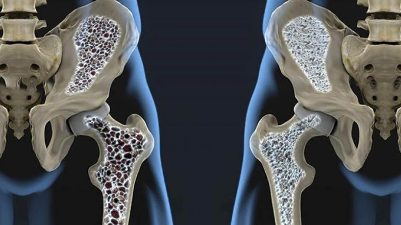 অস্টিওপোরোসিস প্রতিরোধে কী করবেন