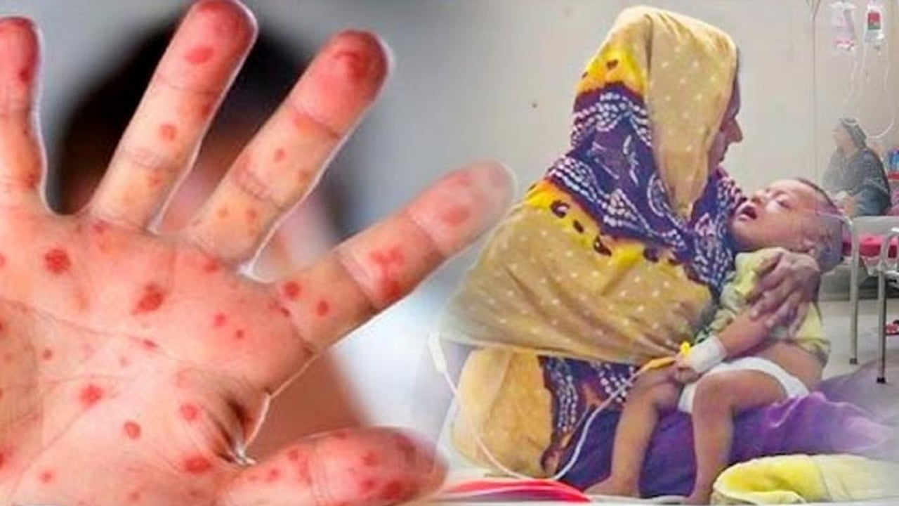 শিশুর হাম হলে তালিকা থেকে বাদ দেবেন যেসব খাবার