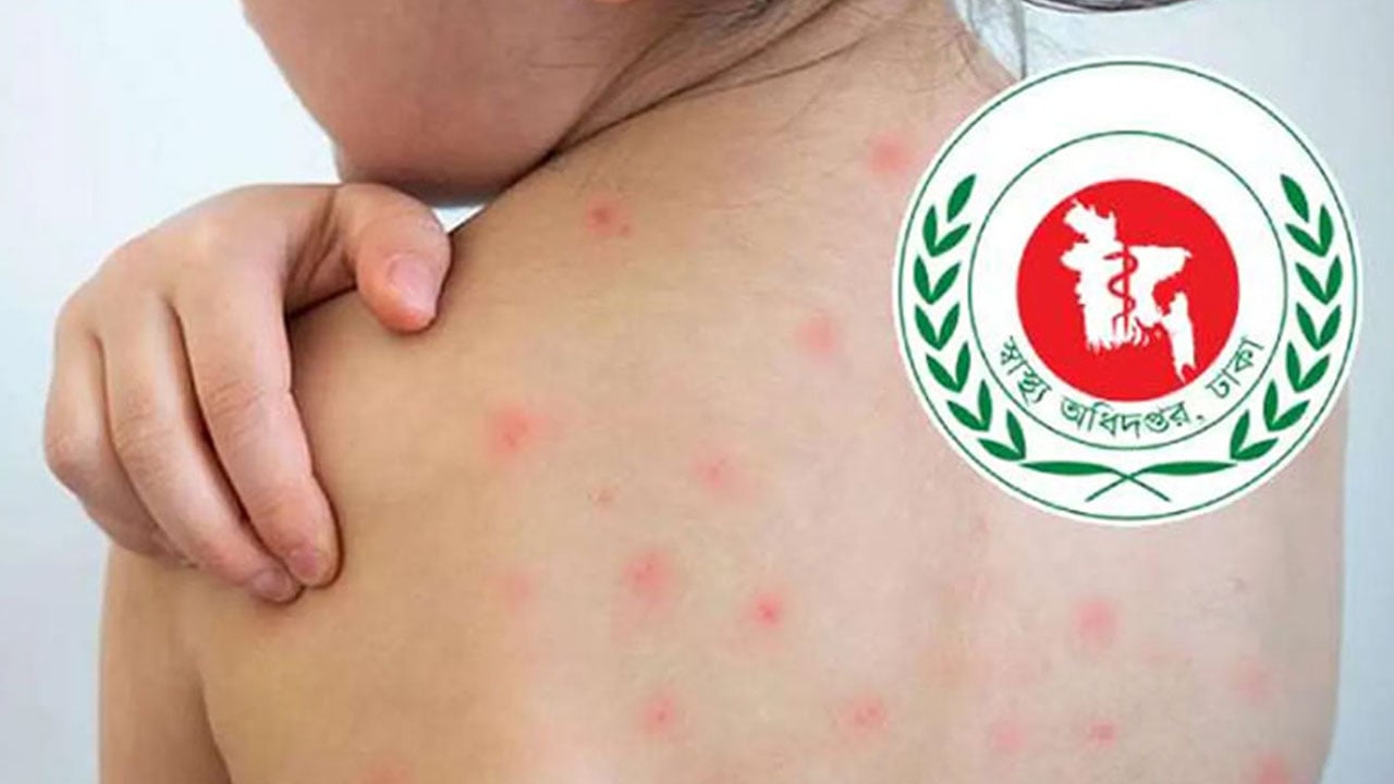 হামের উপসর্গে সিলেটে আরো দুই শিশুর মৃত্যু