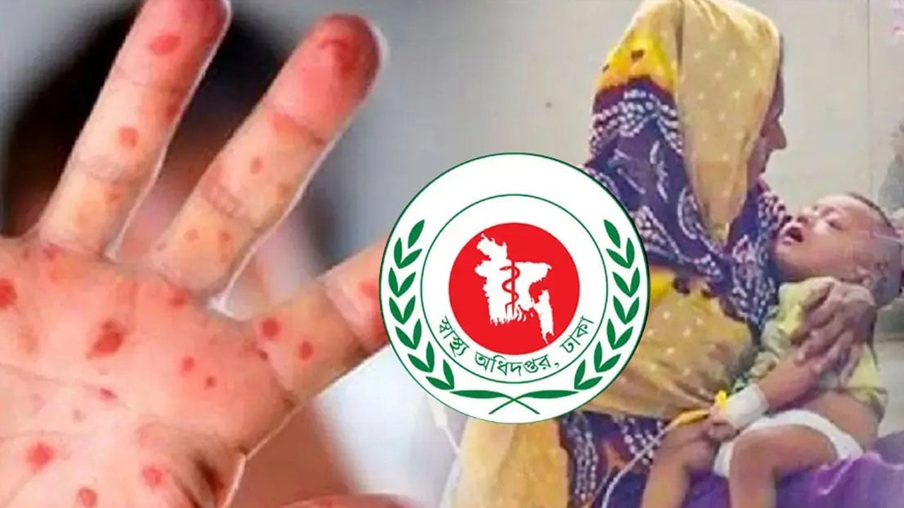 দেশে থামছেই না হামের প্রকোপ, প্রাণ গেল আরো ৫ শিশুর