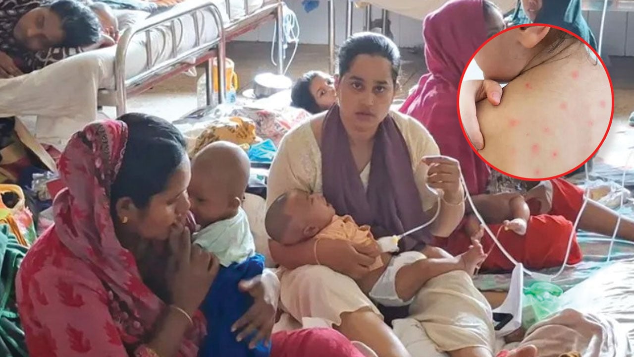 হামের উপসর্গে প্রাণ গেল আরো ৫ শিশুর