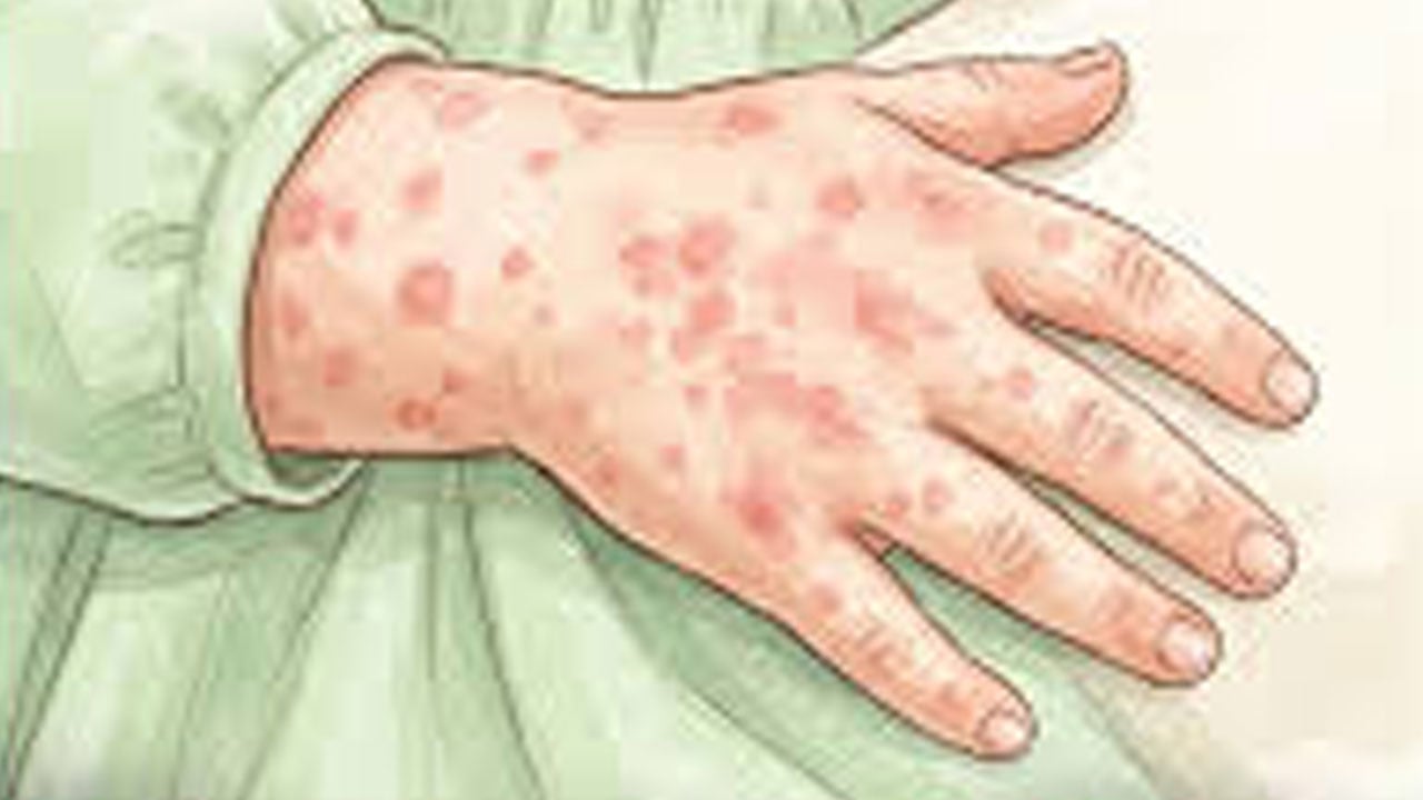 এক দিনে হাম ও উপসর্গে আরো ৫ শিশুর মৃত্যু