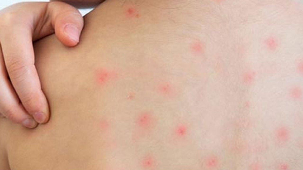 হামের টিকা দিতে ব্যর্থ ড. ইউনূসের সরকার