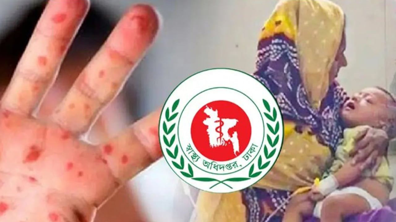 হাম ও উপসর্গে আরও ১১ জনের মৃত্যু