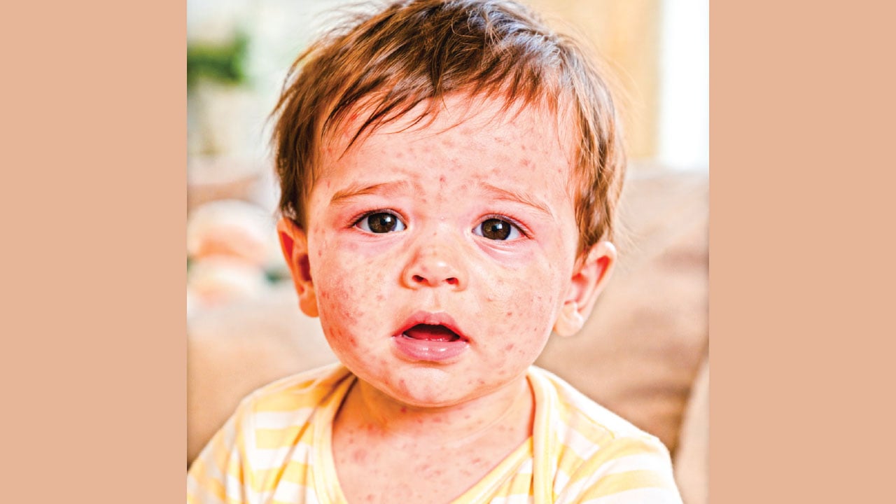 হামের ঝুঁকি ও করণীয়