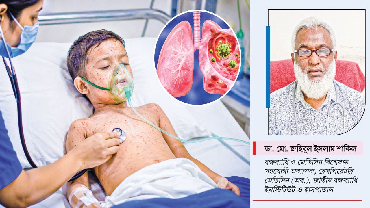 হামের ইনফেকশনে নিউমোনিয়া হতে পারে