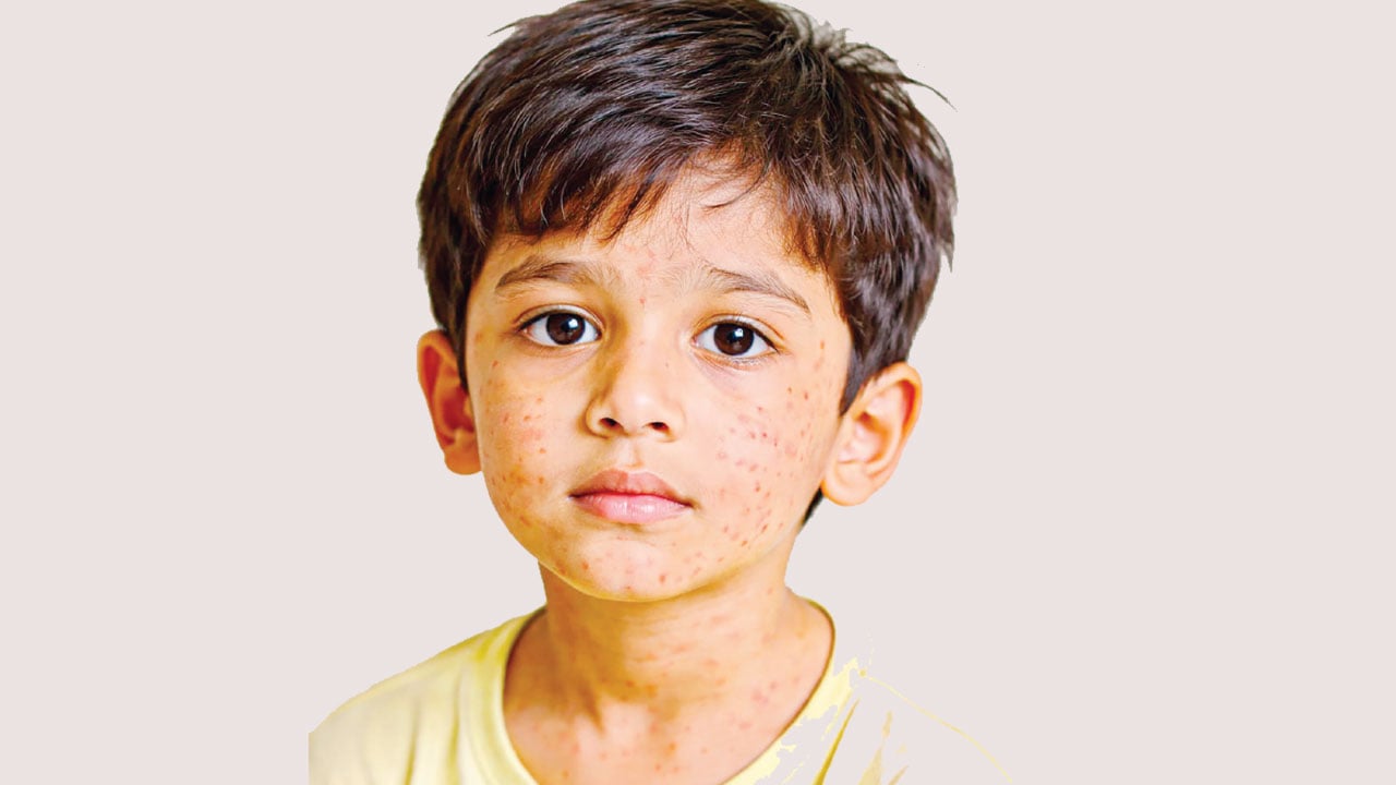 হামের প্রাদুর্ভাবে করণীয়