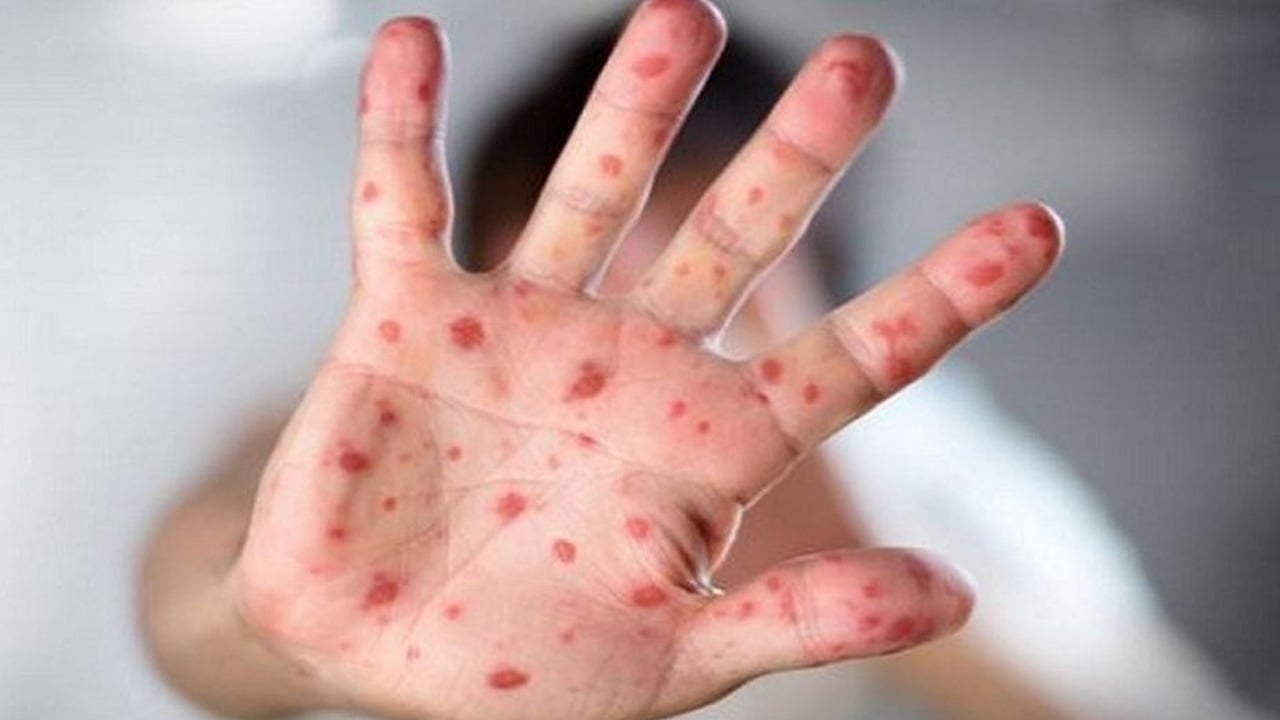 হামের প্রকোপ : সতর্কবার্তা