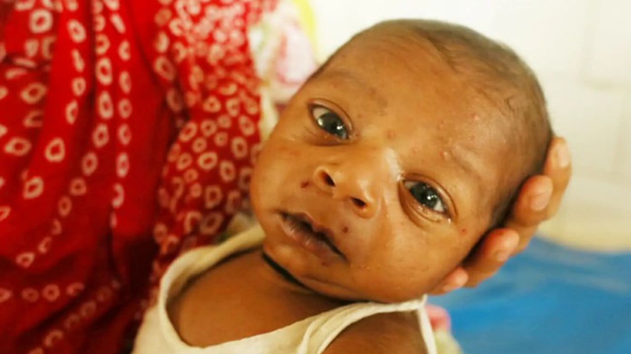 হাম কী, কেন ও কীভাবে ছড়ায়