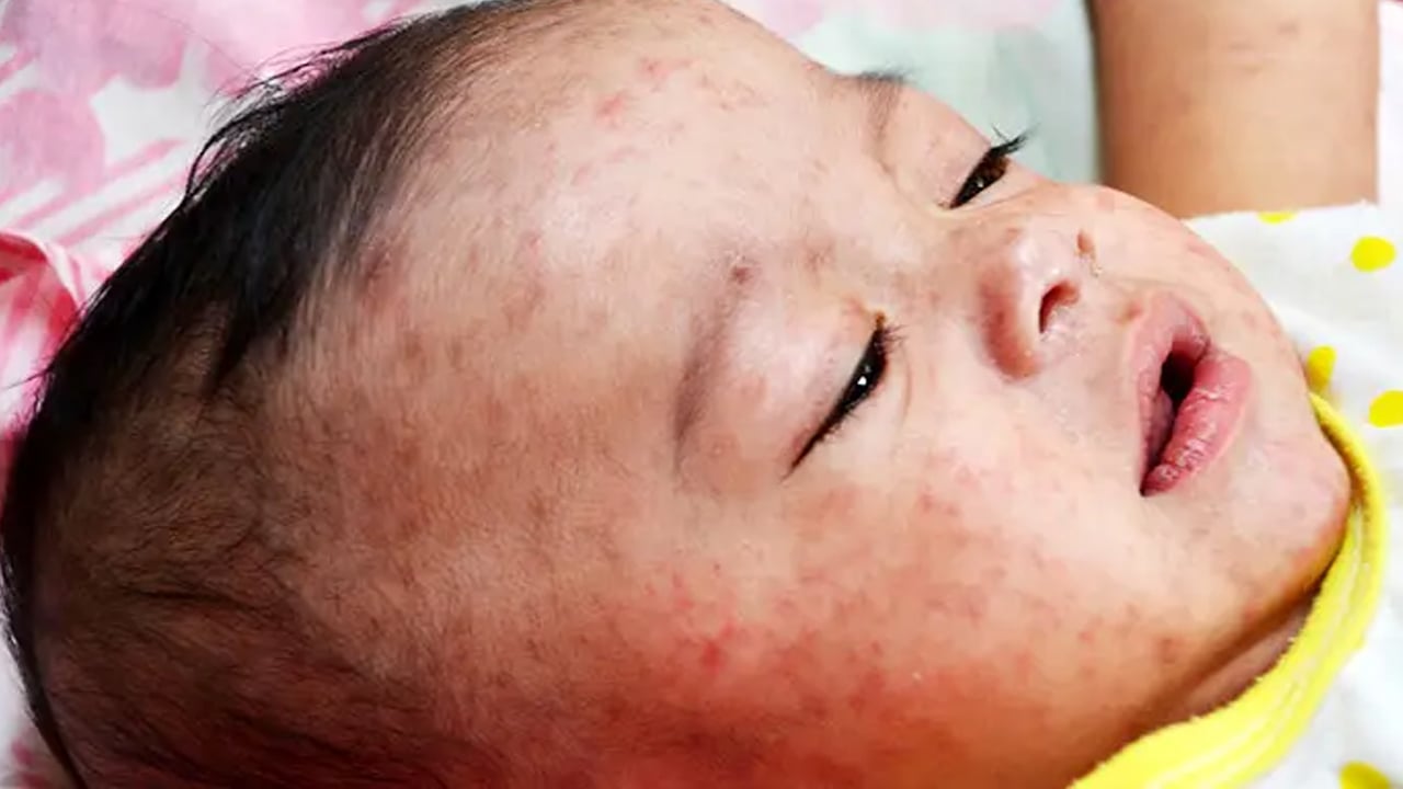 ৬ মাস থেকে ৫ বছরের শিশু পাবে হামের টিকা