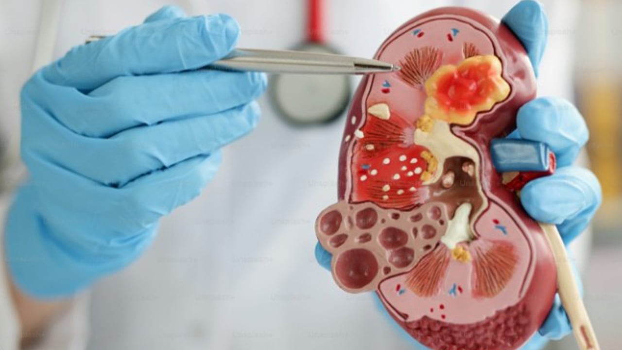 কিডনি রোগের আসল কারণ খুঁজে পেলেন গবেষকরা
