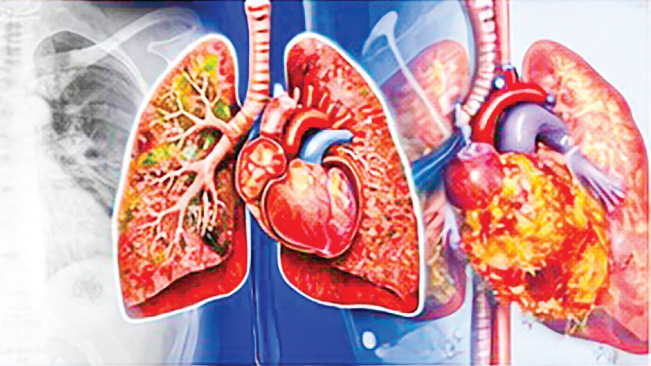 করোনারি ধমনি রোগের চিকিৎসা