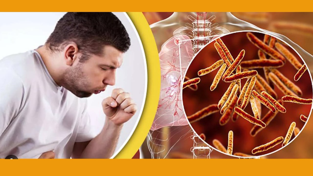 ২১ শতাংশ যক্ষ্মা রোগী এখনো শনাক্তের বাইরে