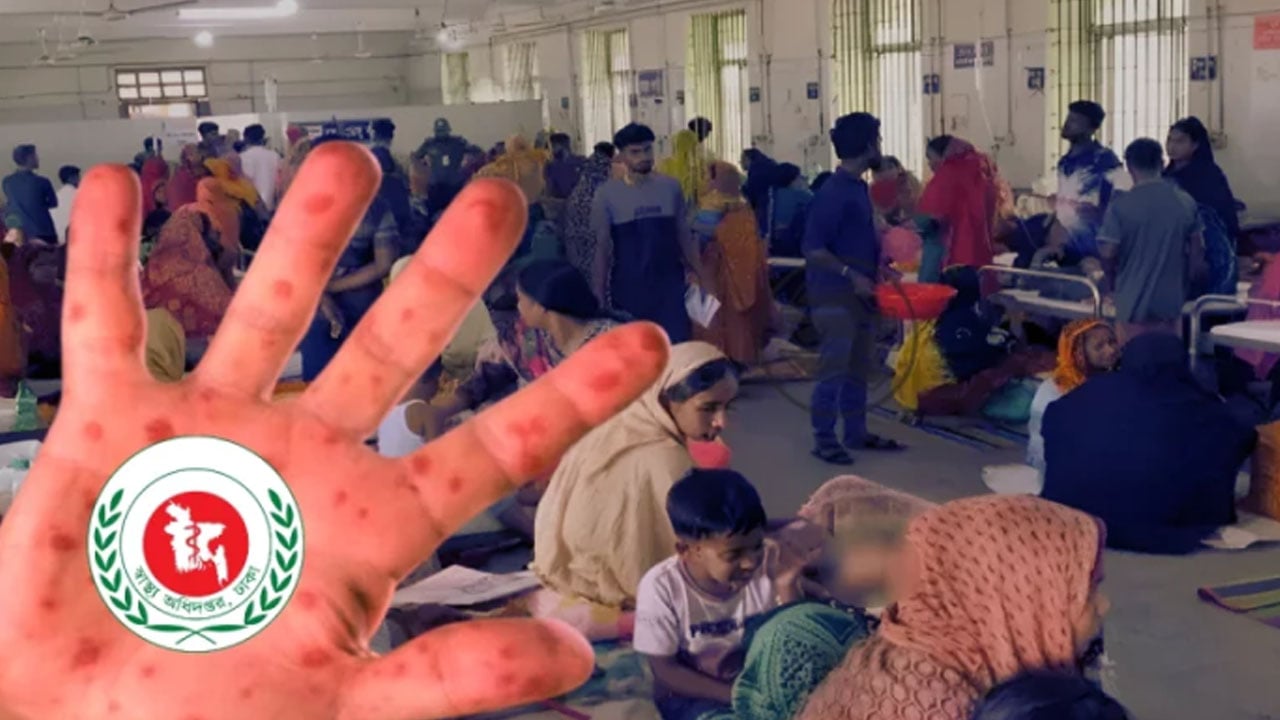সিলেটে হামের উপসর্গে আরো চার শিশুর মৃত্যু