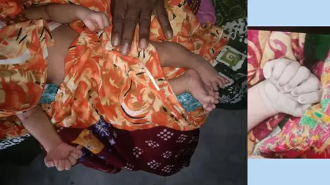 ফুলবাড়ীতে ২৮ আঙুল নিয়ে নবজাতকের জন্ম, এলাকায় চাঞ্চল্য