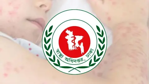 এক দিনে হাম উপসর্গে ৫ জনের মৃত্যু, আক্রান্ত ১৩৫৬