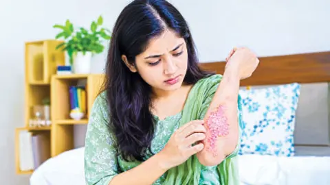 সোরিয়াসিসের লক্ষণ ও ঝুঁকি